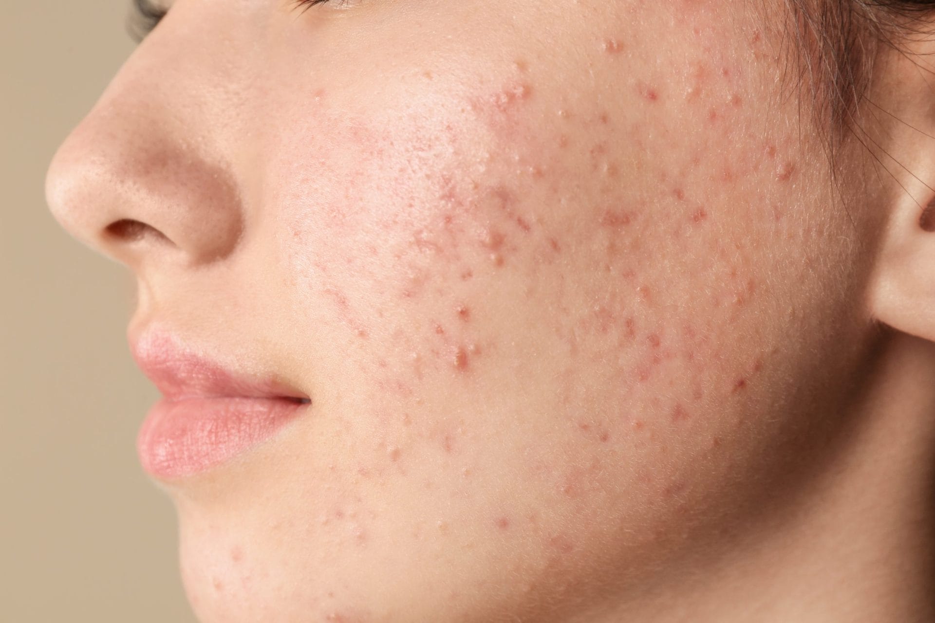 acne