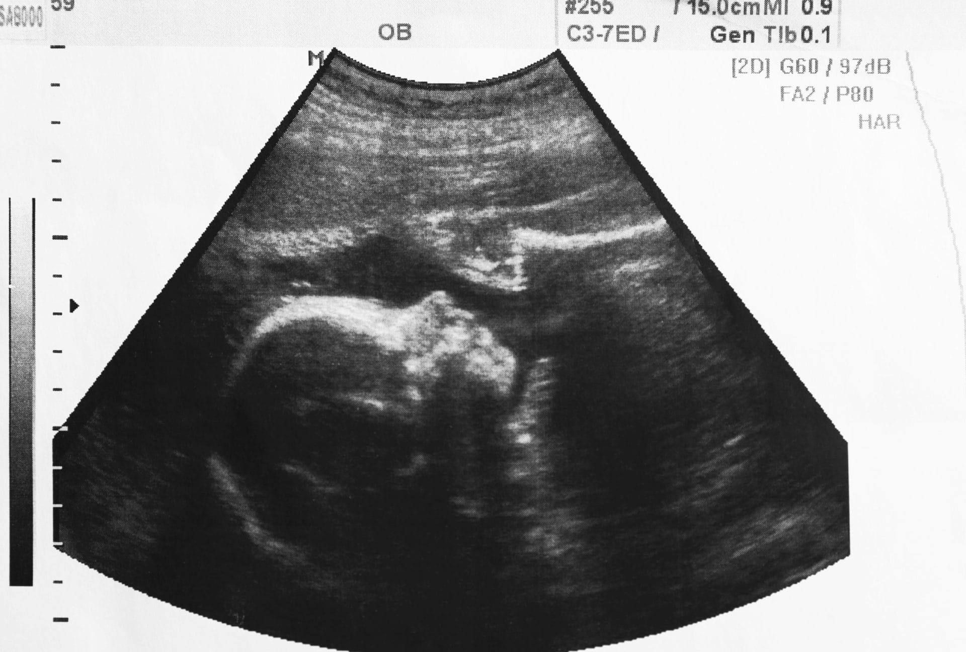 Ultrasound